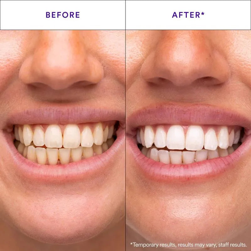 Tiras Blanqueadoras de Dientes