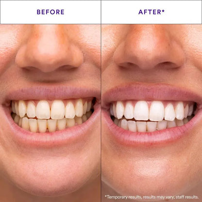 Tiras Blanqueadoras de Dientes